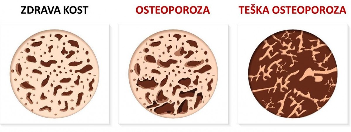 Osteoporoza kosti
